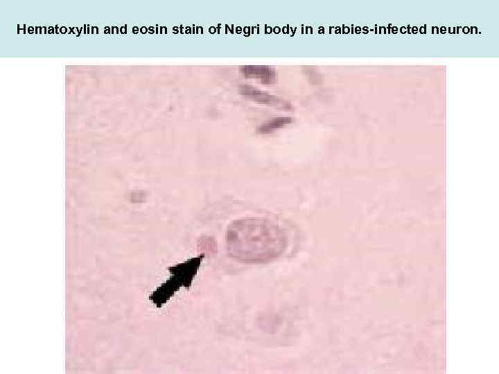 Hematoxylin and eosin stain of Negri body in a rabies-infected neuron. 