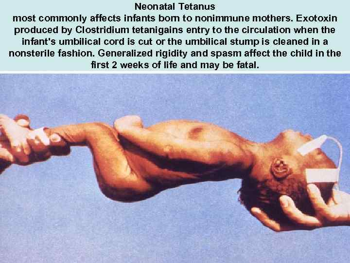 Neonatal Tetanus most commonly affects infants born to nonimmune mothers. Exotoxin produced by Clostridium