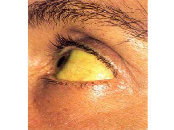 Вирусный гепатит желтушный период. Пожелтение склер гепатит. Механическая желтуха склер. Желтушность кожи гепатит с. Субиктеричность (желтушность) склер;.