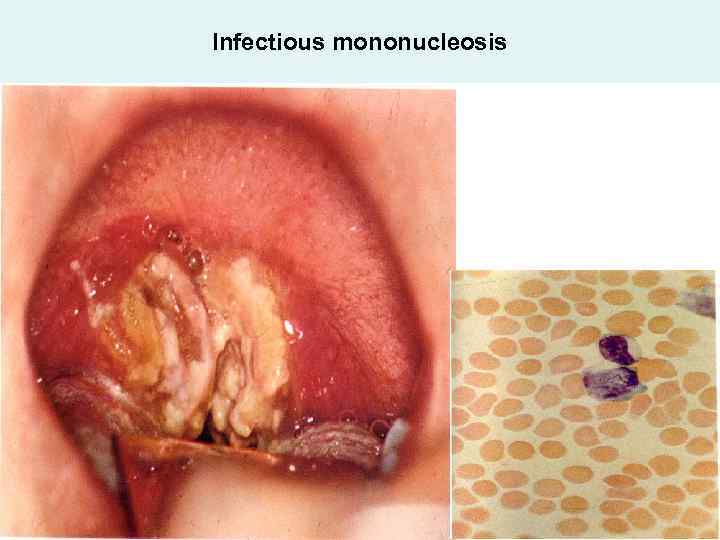 Infectious mononucleosis 