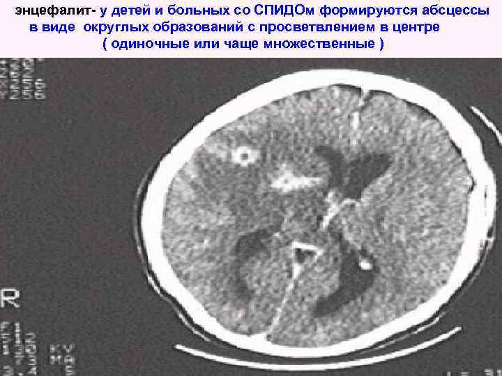 энцефалит- у детей и больных со СПИДОм формируются абсцессы в виде округлых образований с