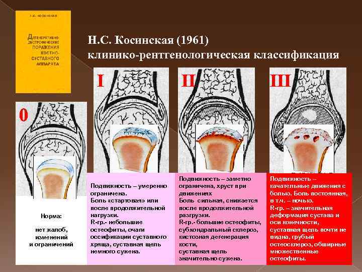 Н. С. Косинская (1961) клинико-рентгенологическая классификация I II III 0 Норма: нет жалоб, изменений