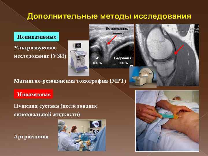 Дополнительные методы исследования Поврежденный мениск Неинвазивные Ультразвуковое исследование (УЗИ) Б/б кость Бедренная кость Магнитно-резонансная