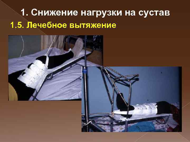 1. Снижение нагрузки на сустав 1. 5. Лечебное вытяжение 