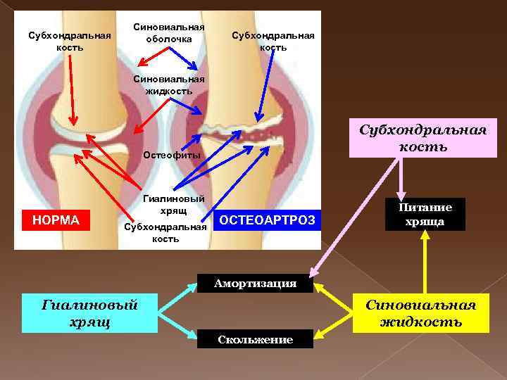 Субхондральная кость Синовиальная оболочка Субхондральная кость Синовиальная жидкость Субхондральная кость Остеофиты НОРМА Гиалиновый хрящ