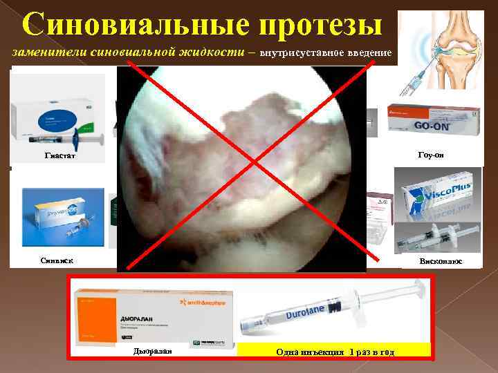 Синовиальные протезы заменители синовиальной жидкости – внутрисуставное введение Гиастат Синокром Синвиск Остенил Дьюралан Первый