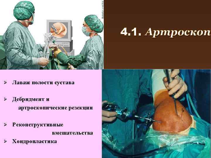 4. 1. Артроскопи Артроскоп Ø Лаваж полости сустава Ø Дебридмент и артроскопические резекции Реконструктивные