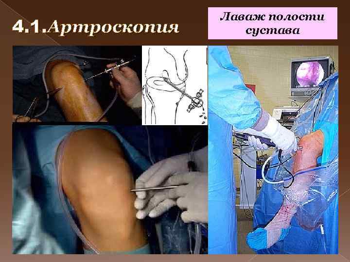 4. 1. Артроскопия Лаваж полости сустава 