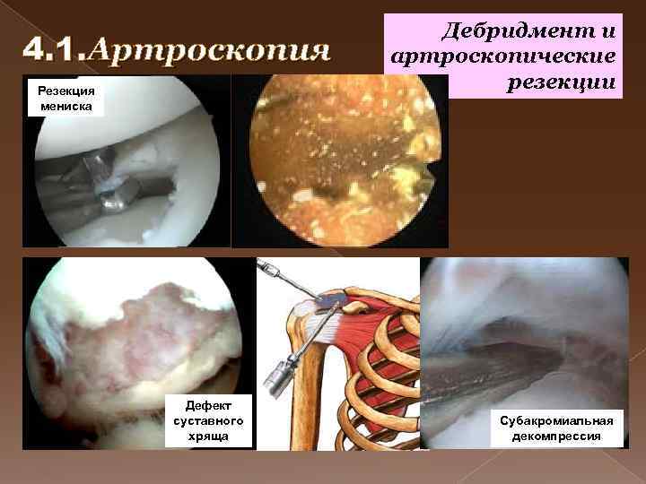 4. 1. Артроскопия Резекция мениска Дефект суставного хряща Дебридмент и артроскопические резекции Субакромиальная декомпрессия