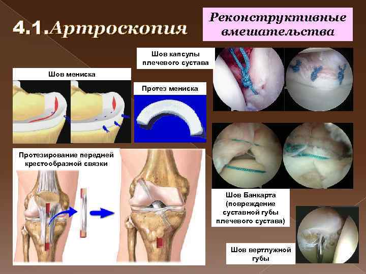 4. 1. Артроскопия Реконструктивные вмешательства Шов капсулы плечевого сустава Шов мениска Протезирование передней крестообразной