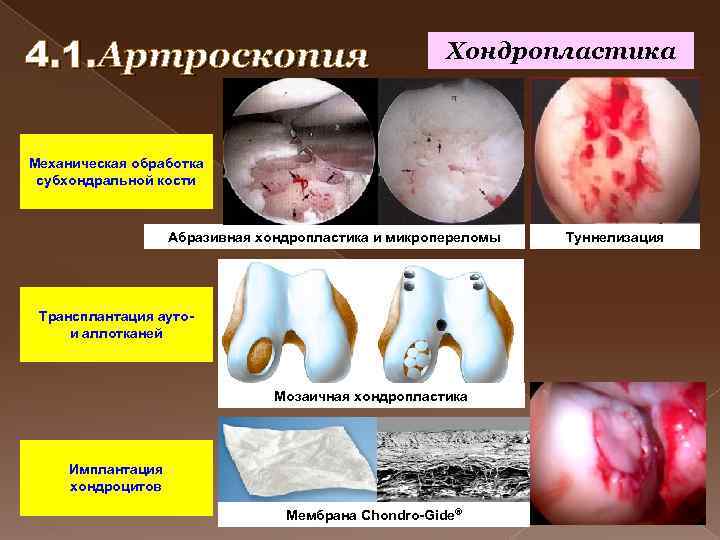 4. 1. Артроскопия Хондропластика Механическая обработка субхондральной кости Абразивная хондропластика и микропереломы Трансплантация ауто-