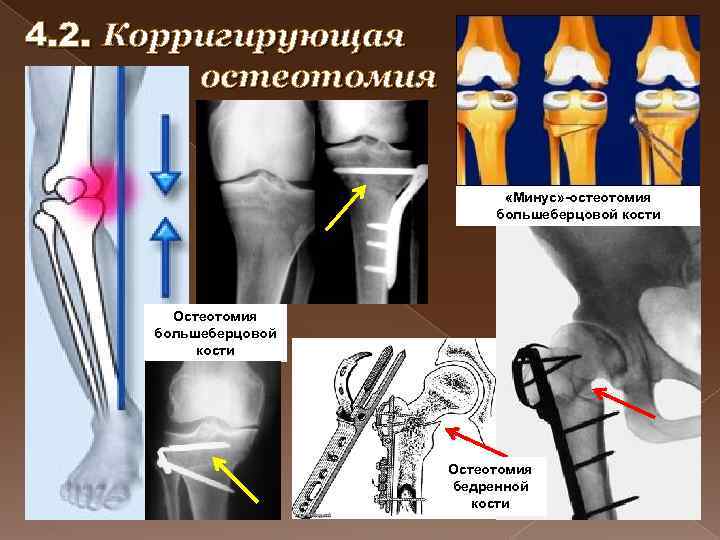 Остеотомия. Операция корригирующая остеотомия бедренной кости. Высокая корригирующая остеотомия большеберцовой кости. Корригирующая остеотомия большеберцовой кости при артрозе. Операция остеотомия большеберцовой кости.