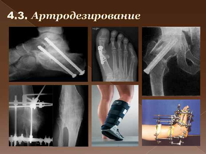 4. 3. Артродезирование 