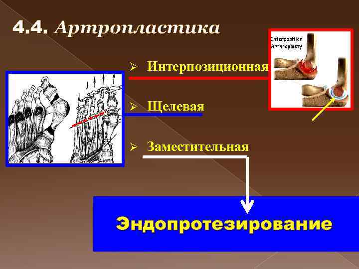 4. 4. Артропластика Ø Интерпозиционная Ø Щелевая Ø Заместительная Эндопротезирование 