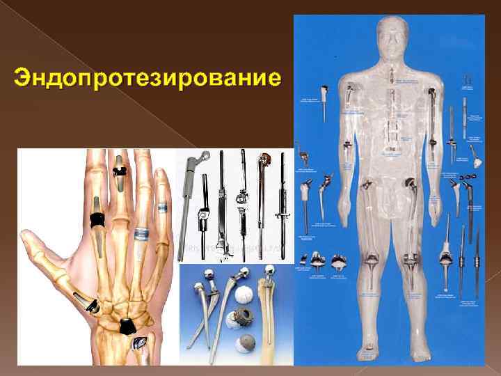 Эндопротезирование 