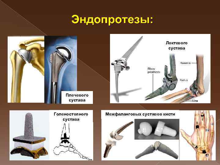 Эндопротезы: Локтевого сустава Плечевого сустава Голеностопного сустава Межфаланговых суставов кисти 