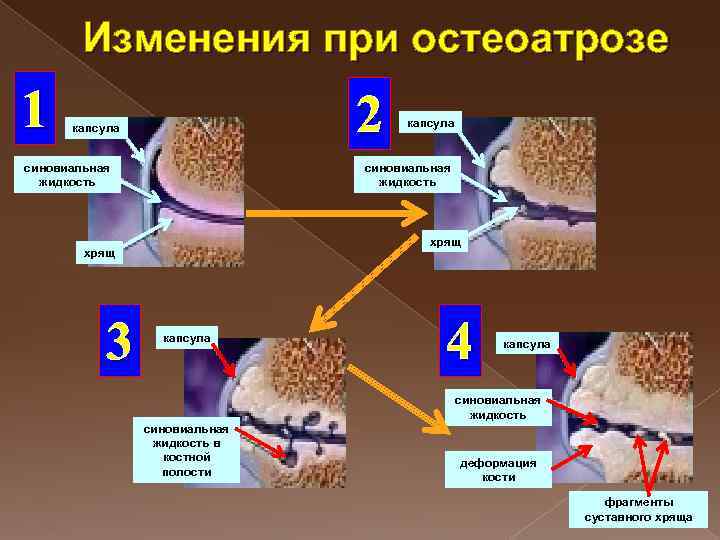 Изменения при остеоатрозе 1 2 капсула синовиальная жидкость хрящ 3 капсула 4 капсула синовиальная
