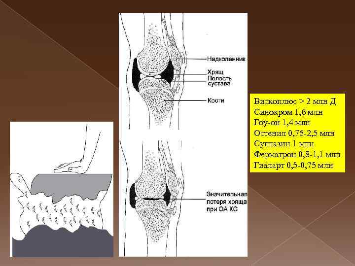 Вископлюс > 2 млн Д Синокром 1, 6 млн Гоу-он 1, 4 млн Остенил
