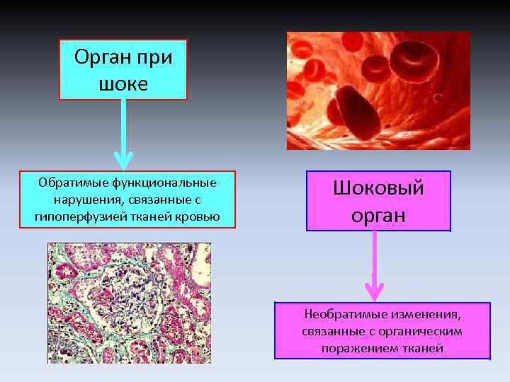 Орган при шоке Обратимые функциональные нарушения, связанные с гипоперфузией тканей кровью Шоковый орган Необратимые