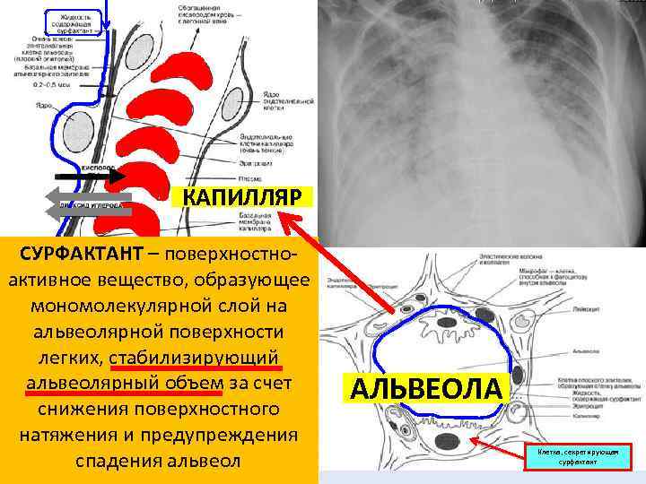 КАПИЛЛЯР СУРФАКТАНТ – поверхностноактивное вещество, образующее мономолекулярной слой на альвеолярной поверхности легких, стабилизирующий альвеолярный