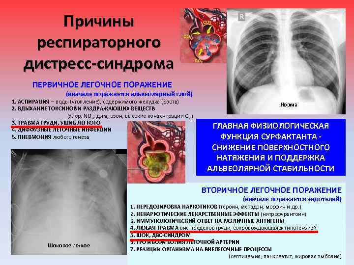 Причины респираторного дистресс-синдрома ПЕРВИЧНОЕ ЛЕГОЧНОЕ ПОРАЖЕНИЕ (вначале поражается альвеолярный слой) 1. АСПИРАЦИЯ – воды