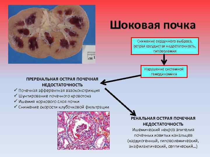 Шоковая почка Снижение сердечного выброса, острая сосудистая недостаточность, гиповолемия ПРЕРЕНАЛЬНАЯ ОСТРАЯ ПОЧЕЧНАЯ НЕДОСТАТОЧНОСТЬ ü