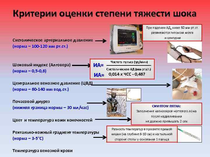 Критерии оценки степени тяжести шока При падении АДс ниже 60 мм рт. ст. развиваются