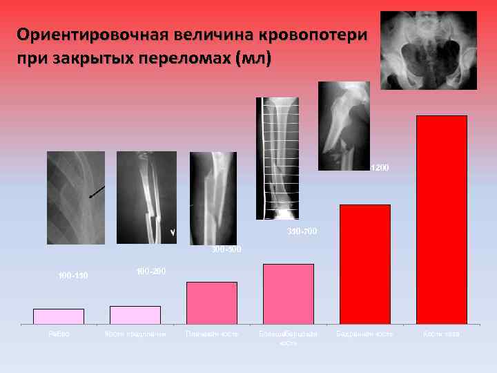 Ориентировочная величина кровопотери при закрытых переломах (мл) 1500 -2000 800 -1200 350 -700 300