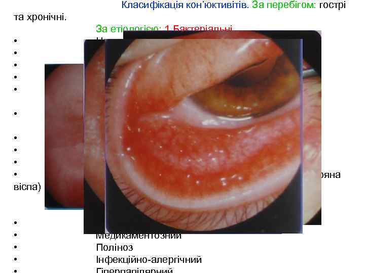Класифікація кон’юктивітів. За перебігом: гострі та хронічні. • • • віспа) • • За