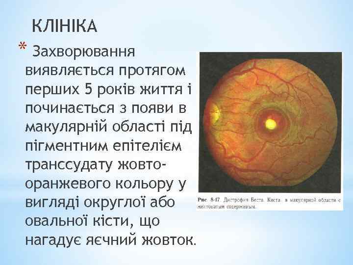 КЛІНІКА * Захворювання виявляється протягом перших 5 років життя і починається з появи в