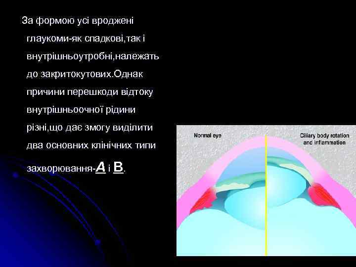 За формою усі вроджені глаукоми-як спадкові, так і внутрішньоутробні, належать до закритокутових. Однак причини