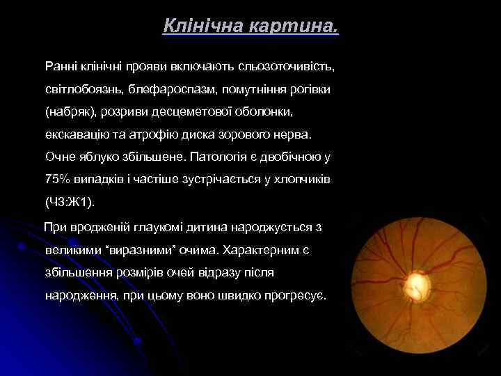 Клінічна картина. Ранні клінічні прояви включають сльозоточивість, світлобоязнь, блефароспазм, помутніння рогівки (набряк), розриви десцеметової