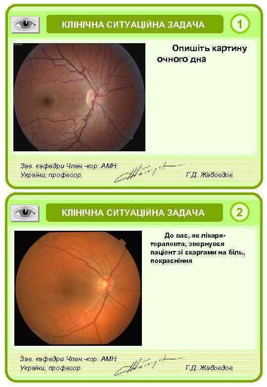 КЛІНІЧНА СИТУАЦІЙНА ЗАДАЧА 1 Опишіть картину очного дна Зав. кафедри Член. -кор. АМН України,