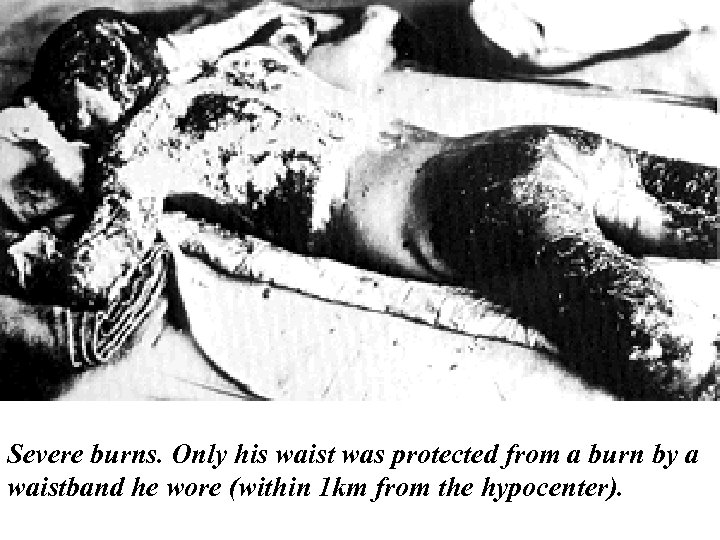 Severe burns. Only his waist was protected from a burn by a waistband he