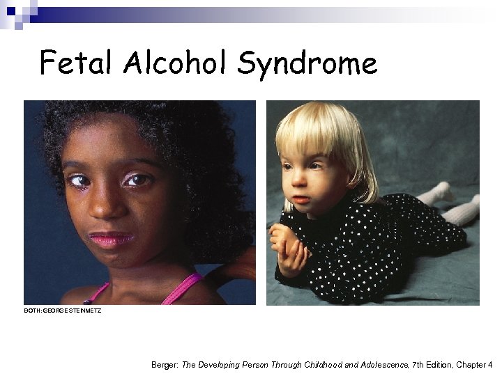 Fetal Alcohol Syndrome BOTH: GEORGE STEINMETZ Berger: The Developing Person Through Childhood and Adolescence,