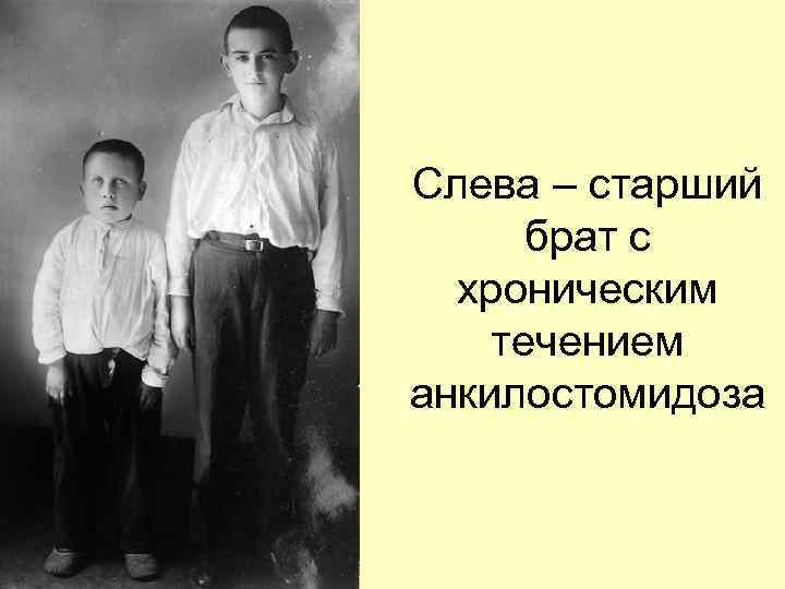 Слева – старший брат с хроническим течением анкилостомидоза 