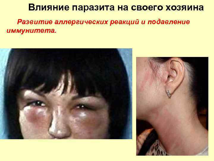 Влияние паразита на своего хозяина Развитие аллергических реакций и подавление иммунитета. 
