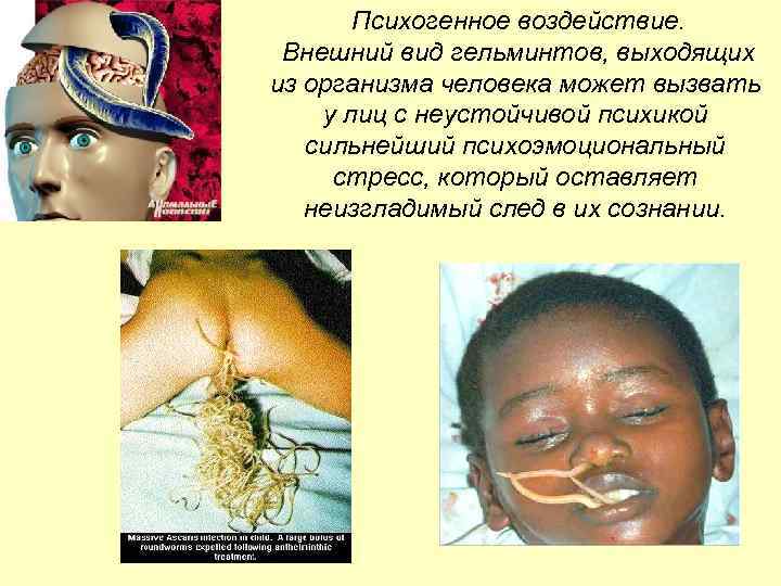 Психогенное воздействие. Внешний вид гельминтов, выходящих из организма человека может вызвать у лиц с