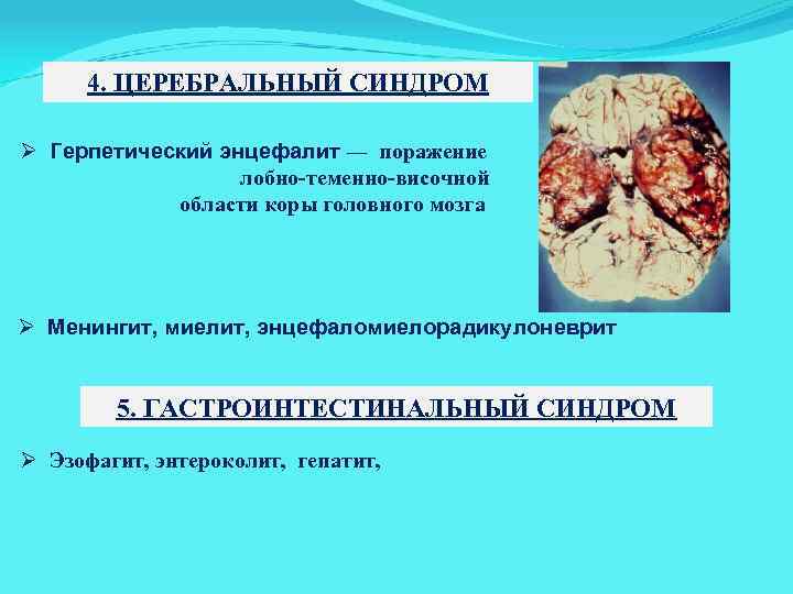 4. ЦЕРЕБРАЛЬНЫЙ СИНДРОМ Ø Герпетический энцефалит ― поражение лобно-теменно-височной области коры головного мозга Ø