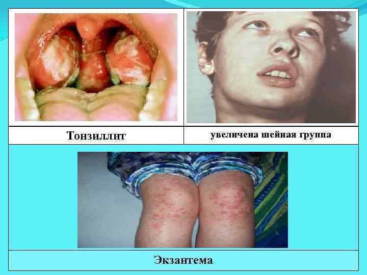 Тонзиллит увеличена шейная группа Экзантема 