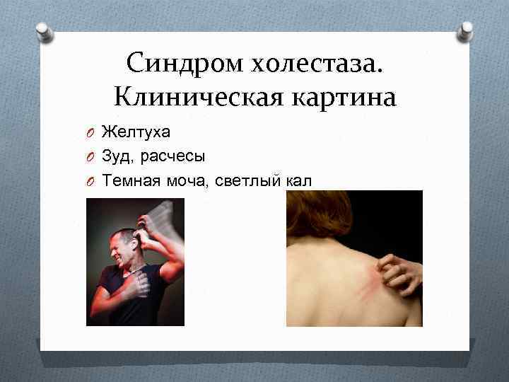 Синдром холестаза. Клиническая картина O Желтуха O Зуд, расчесы O Темная моча, светлый кал