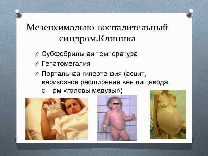 Мезенхимально-воспалительный синдром. Клиника O Субфебрильная температура O Гепатомегалия O Портальная гипертензия (асцит, варикозное расширение