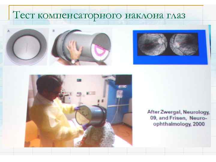 Тест компенсаторного наклона глаз 