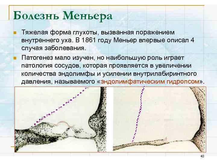 Болезнь Меньера n n Тяжелая форма глухоты, вызванная поражением внутреннего уха. В 1861 году
