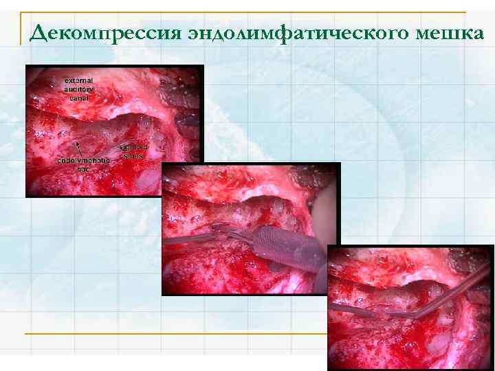 Декомпрессия эндолимфатического мешка 