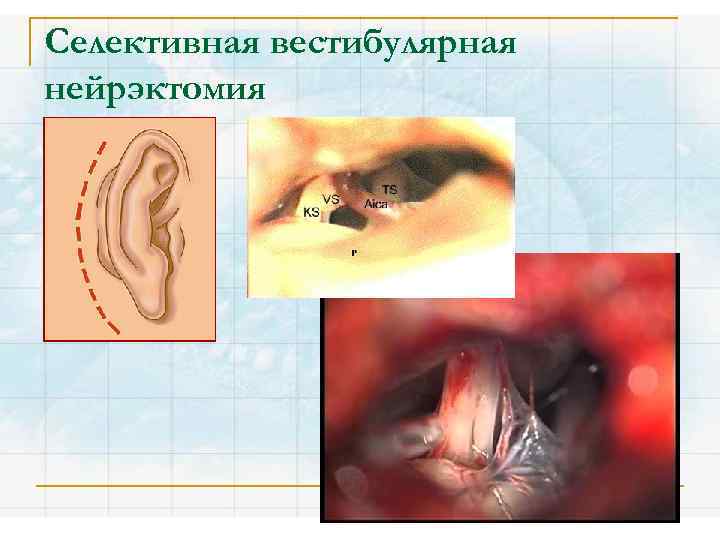 Селективная вестибулярная нейрэктомия 