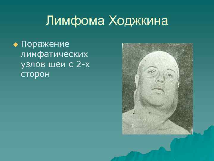 Лимфома Ходжкина u Поражение лимфатических узлов шеи с 2 -х сторон 