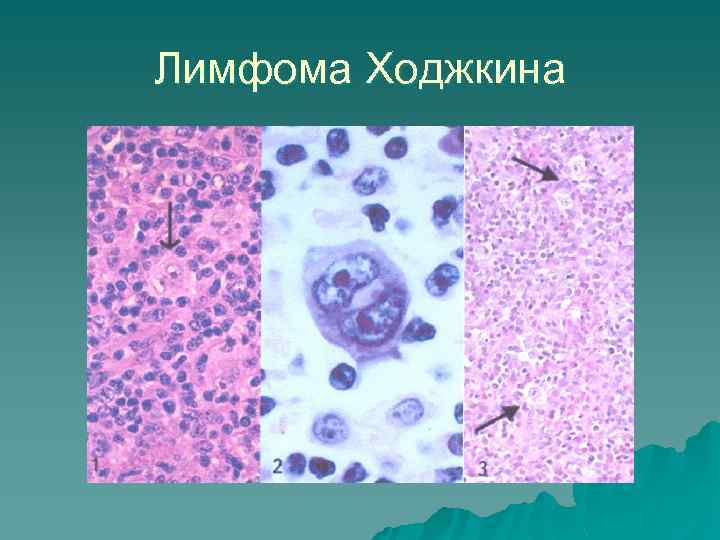 Лимфома Ходжкина 