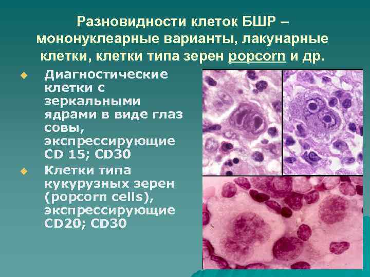 Разновидности клеток БШР – мононуклеарные варианты, лакунарные клетки, клетки типа зерен popcоrn и др.