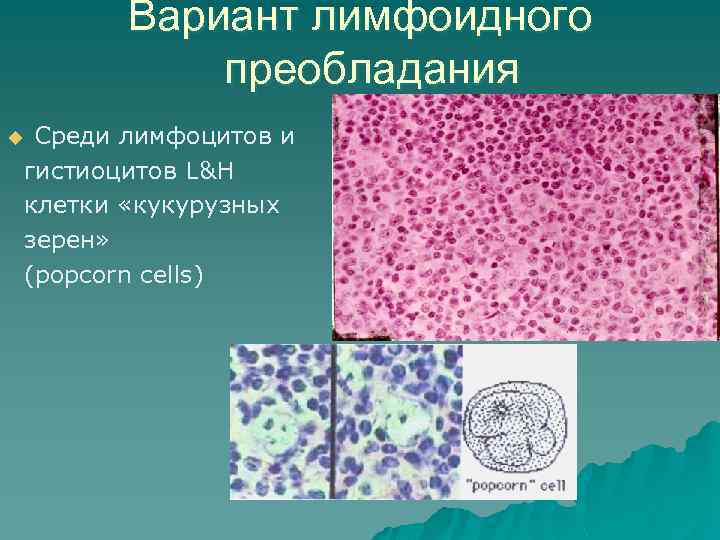 Вариант лимфоидного преобладания Среди лимфоцитов и гистиоцитов L&H клетки «кукурузных зерен» (popcorn cells) u